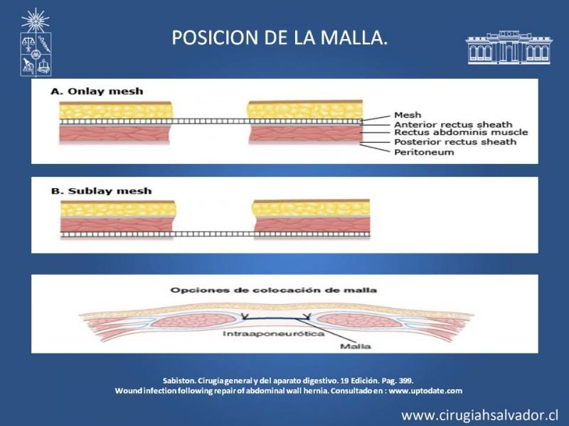 Diapositiva 10 de Hernia incisional: Alternativas de tratamiento
