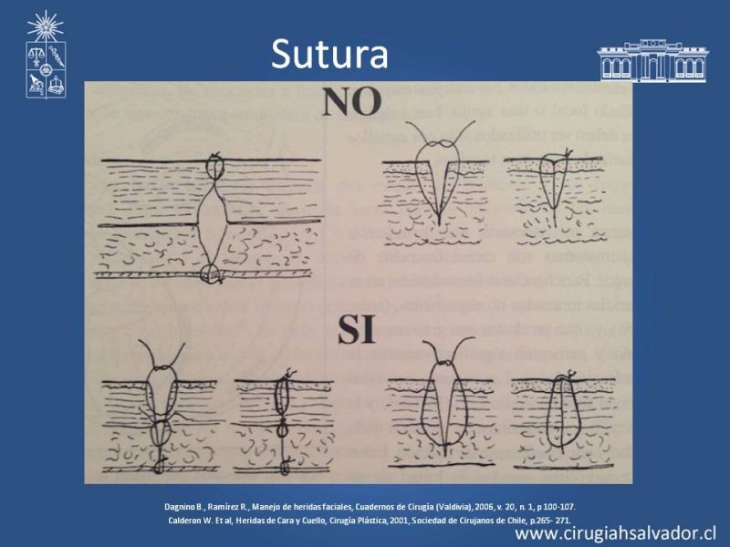 Diapositiva 16 de Heridas faciales complejas