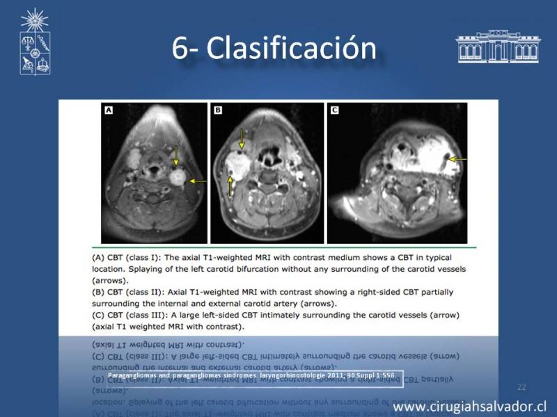 Diapositiva 21 de Paraganglioma cervical