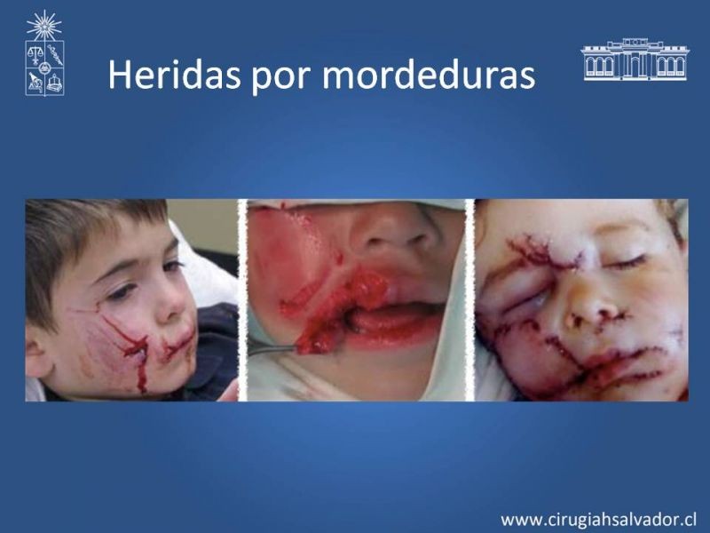 Diapositiva 19 de Heridas faciales complejas