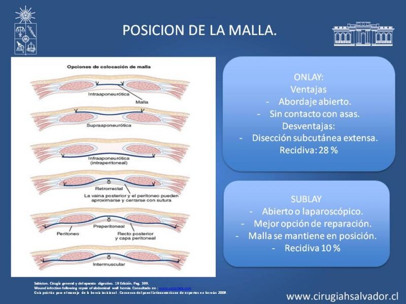 Diapositiva 11 de Hernia incisional: Alternativas de tratamiento