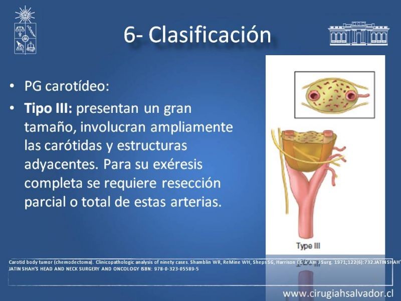 Diapositiva 20 de Paraganglioma cervical