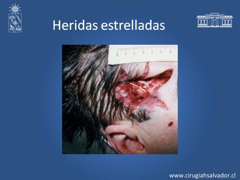Diapositiva 21 de Heridas faciales complejas