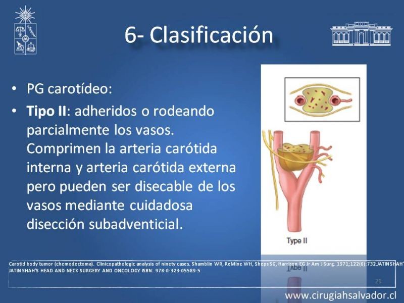 Diapositiva 19 de Paraganglioma cervical