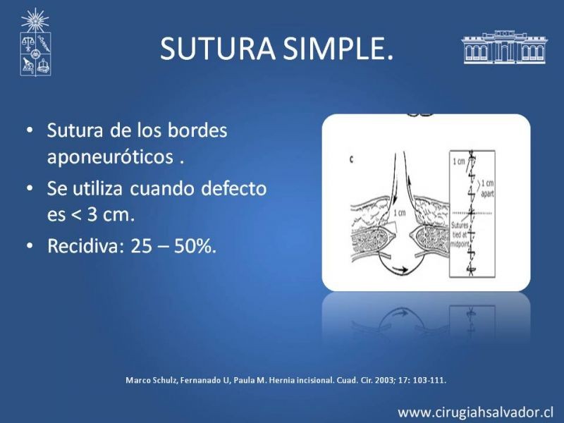 Diapositiva 5 de Hernia incisional: Alternativas de tratamiento