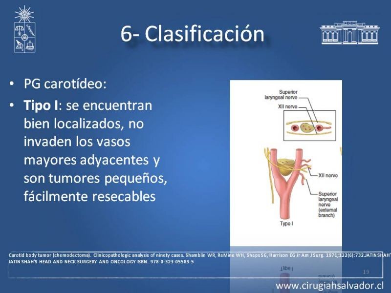 Diapositiva 18 de Paraganglioma cervical
