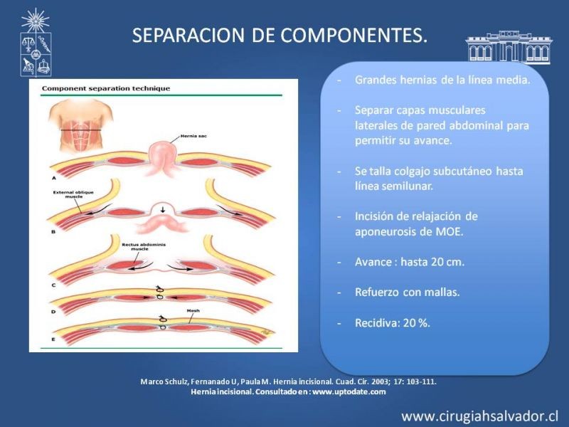 Diapositiva 12 de Hernia incisional: Alternativas de tratamiento