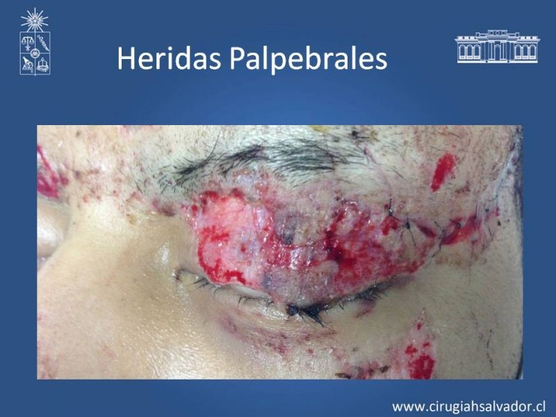 Diapositiva 24 de Heridas faciales complejas