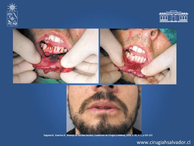 Diapositiva 28 de Heridas faciales complejas