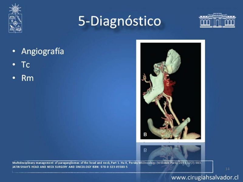 Diapositiva 13 de Paraganglioma cervical
