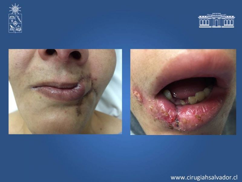 Diapositiva 29 de Heridas faciales complejas