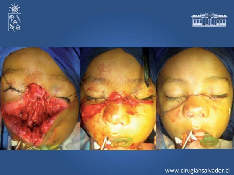 Diapositiva 35 de Heridas faciales complejas
