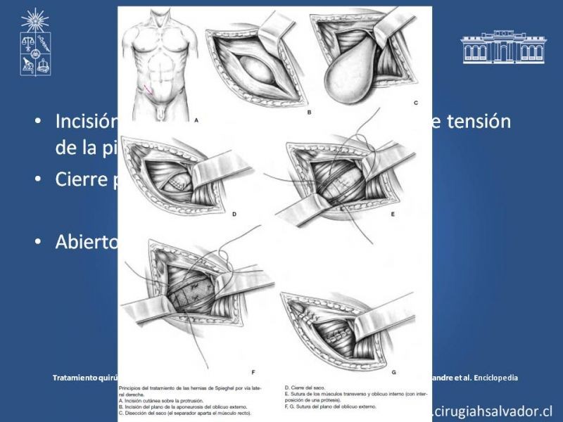Diapositiva 5 de Hernia Spiegel