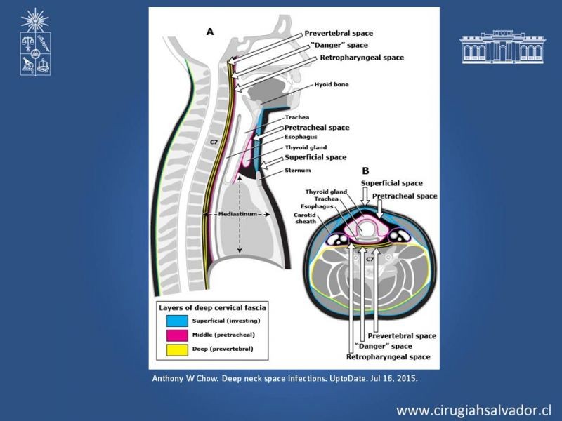 Diapositiva 19 de Absceso cervical y vías de abordaje