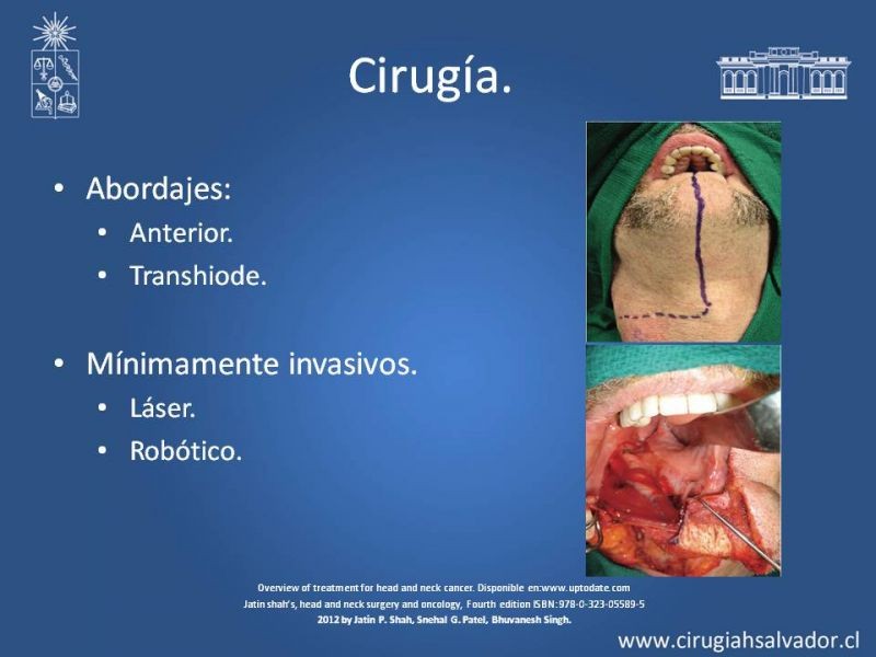 Diapositiva 19 de Cáncer de amígdala