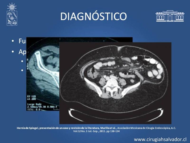 Diapositiva 4 de Hernia Spiegel