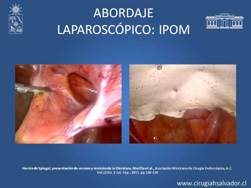 Diapositiva 8 de Hernia Spiegel