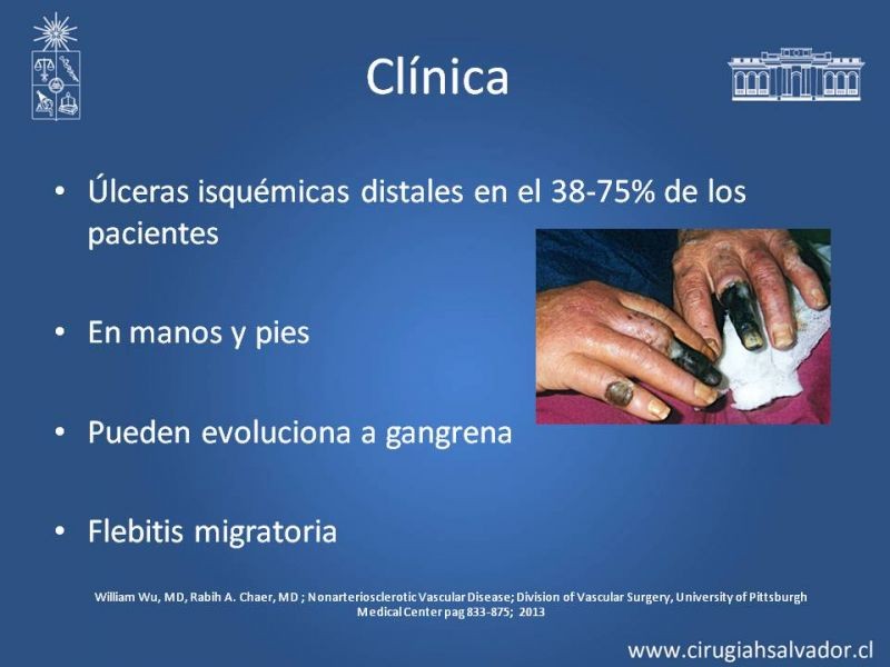 Diapositiva 6 de Enfermedad arterial no aterosclerótica