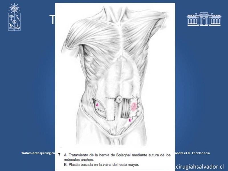 Diapositiva 6 de Hernia Spiegel