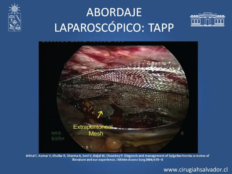 Diapositiva 9 de Hernia Spiegel