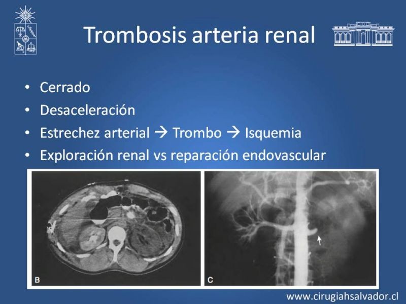 Diapositiva 18 de Manejo Quirúrgico del Trauma Renal