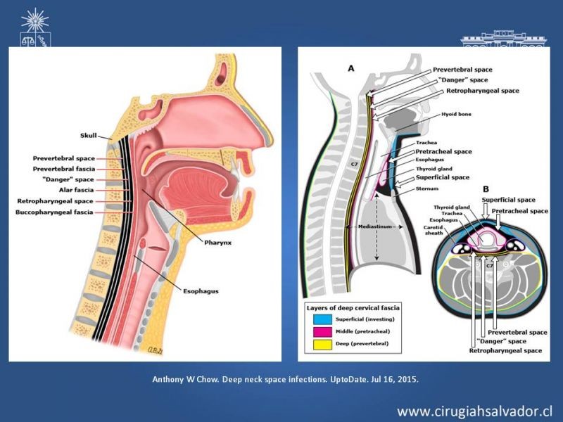 Diapositiva 13 de Absceso cervical y vías de abordaje
