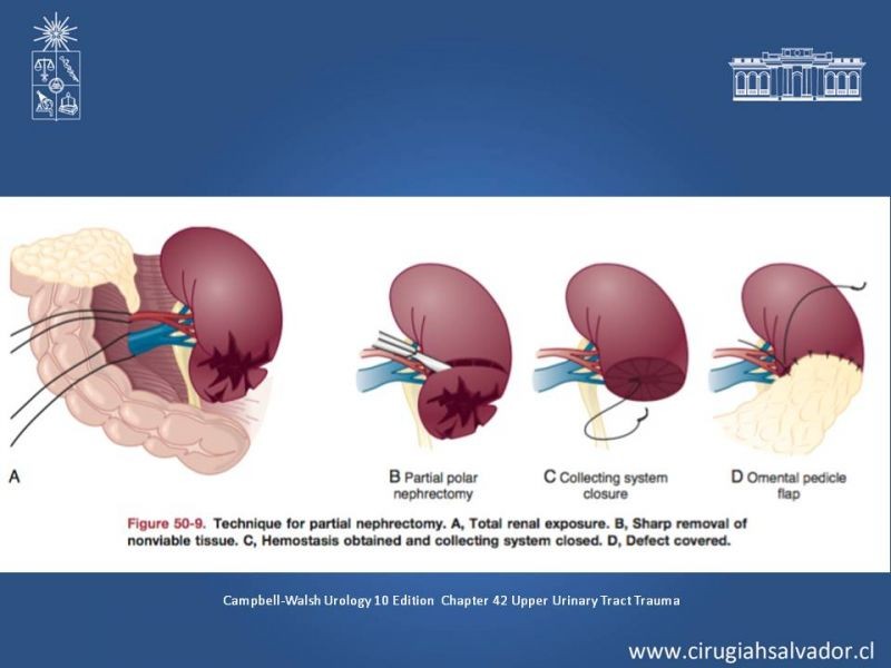 Diapositiva 15 de Manejo Quirúrgico del Trauma Renal