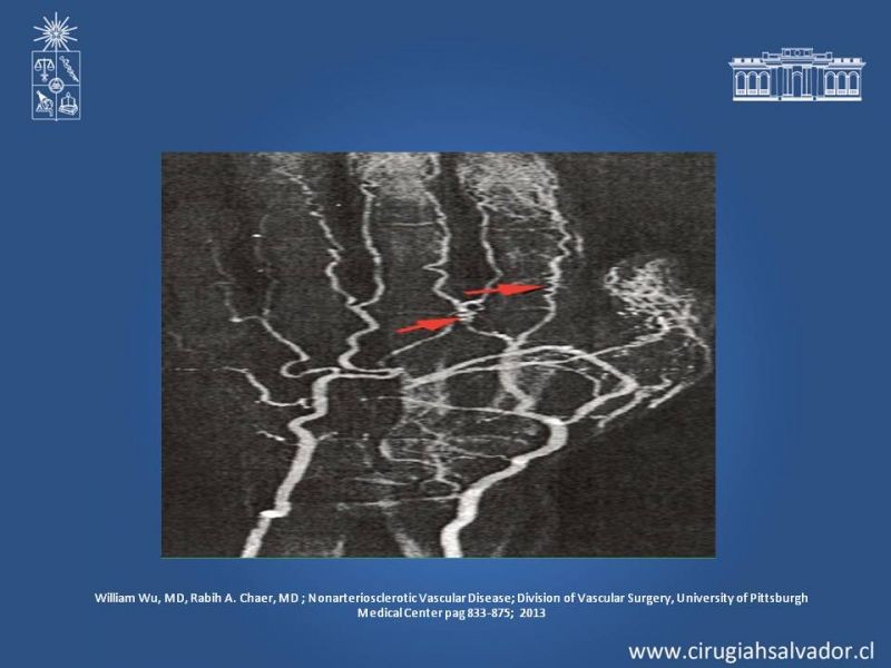 Diapositiva 8 de Enfermedad arterial no aterosclerótica