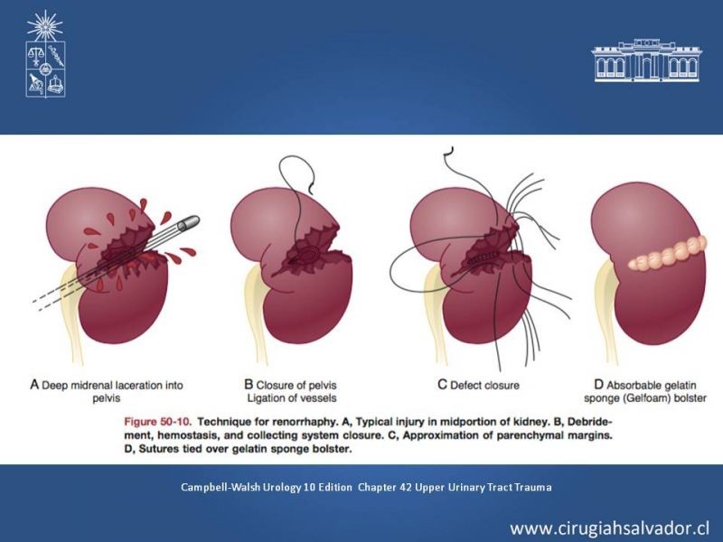 Diapositiva 16 de Manejo Quirúrgico del Trauma Renal
