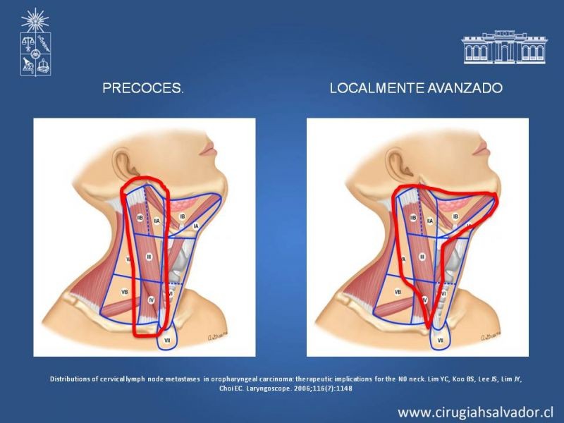 Diapositiva 17 de Cáncer de amígdala