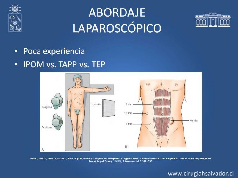 Diapositiva 7 de Hernia Spiegel