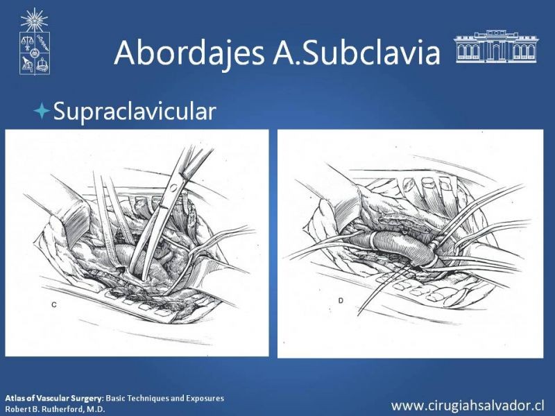 Diapositiva 23 de Anatomía Quirúrgica y Accesos de Carótida, vertebrales y subclavia