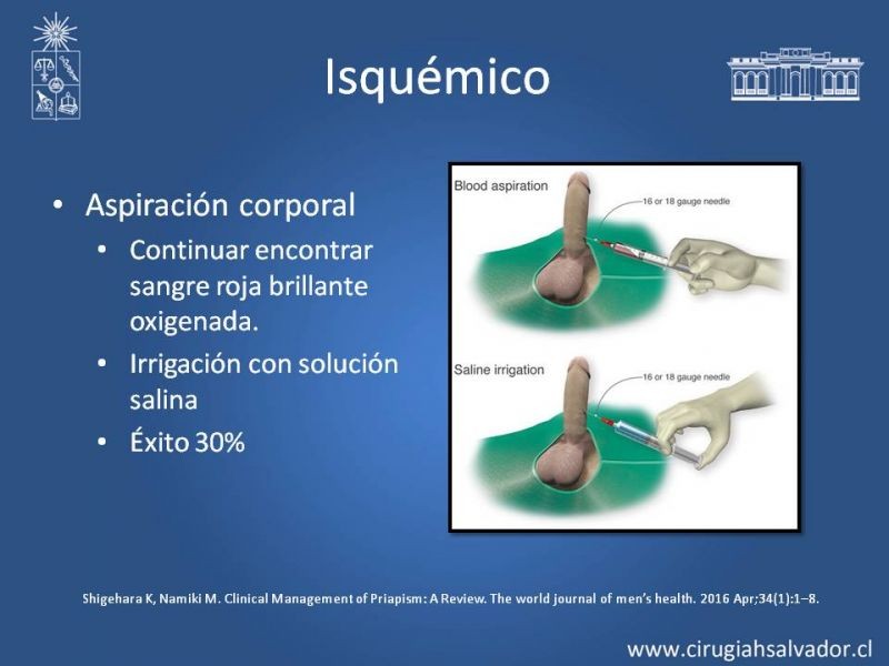Diapositiva 19 de Priapismo