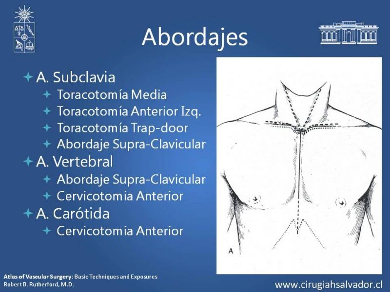 Diapositiva 33 de Anatomía Quirúrgica y Accesos de Carótida, vertebrales y subclavia