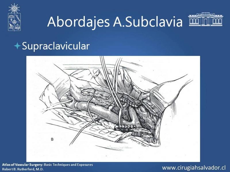 Diapositiva 24 de Anatomía Quirúrgica y Accesos de Carótida, vertebrales y subclavia
