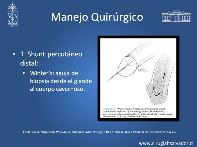Diapositiva 25 de Priapismo