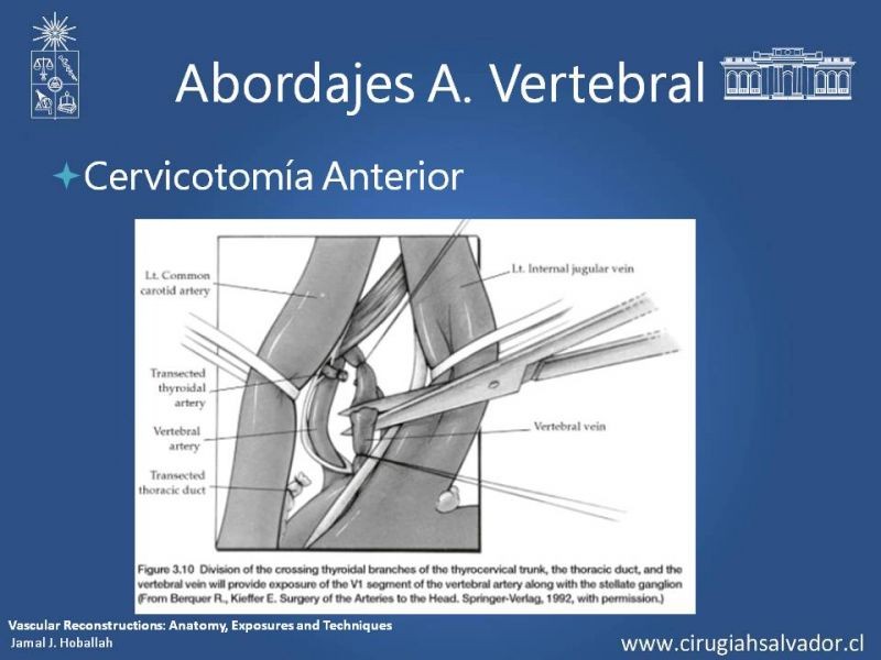 Diapositiva 29 de Anatomía Quirúrgica y Accesos de Carótida, vertebrales y subclavia