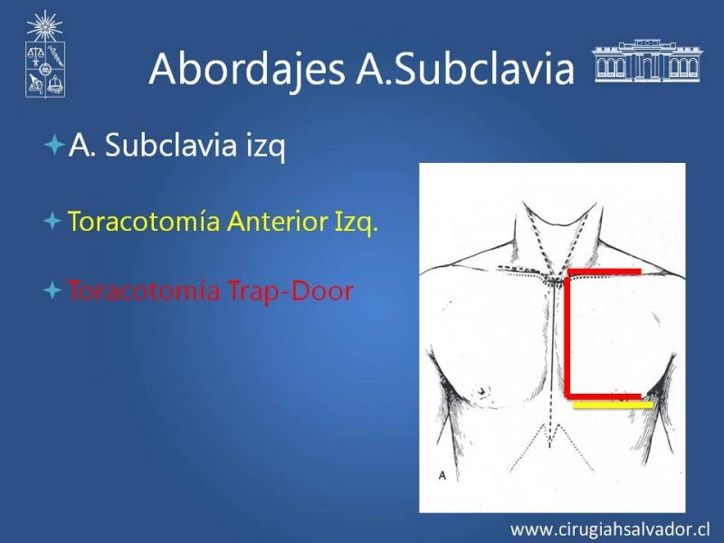 Diapositiva 15 de Anatomía Quirúrgica y Accesos de Carótida, vertebrales y subclavia