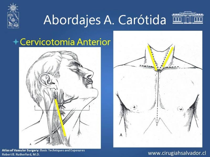 Diapositiva 30 de Anatomía Quirúrgica y Accesos de Carótida, vertebrales y subclavia