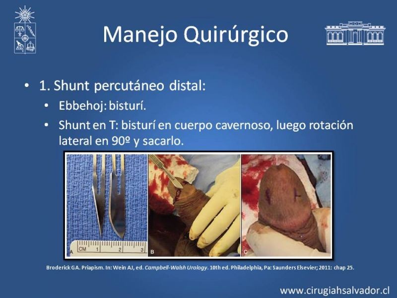 Diapositiva 26 de Priapismo