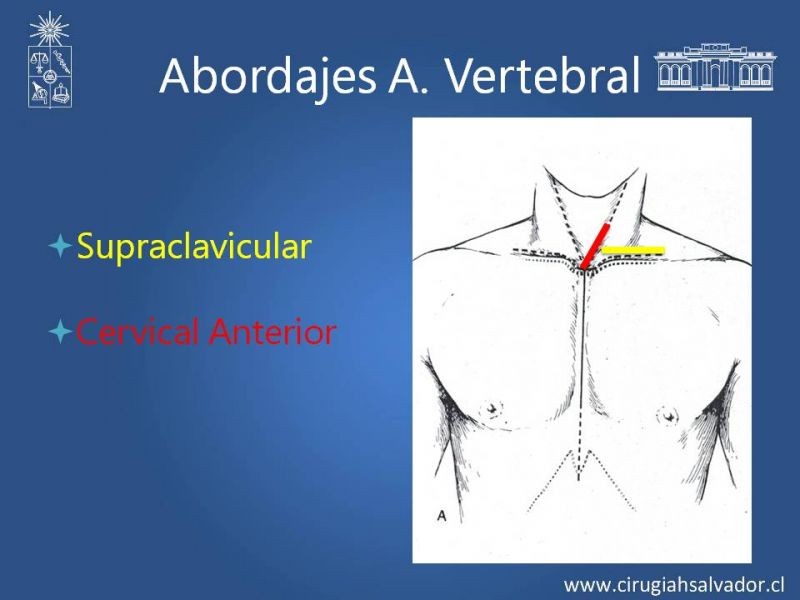 Diapositiva 26 de Anatomía Quirúrgica y Accesos de Carótida, vertebrales y subclavia
