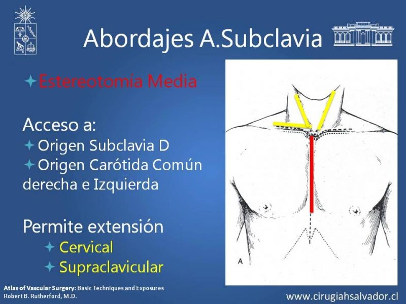 Diapositiva 11 de Anatomía Quirúrgica y Accesos de Carótida, vertebrales y subclavia