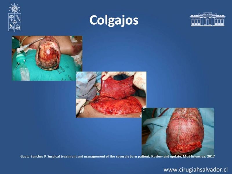 Diapositiva 26 de Manejo Quirúrgico del Gran Quemado