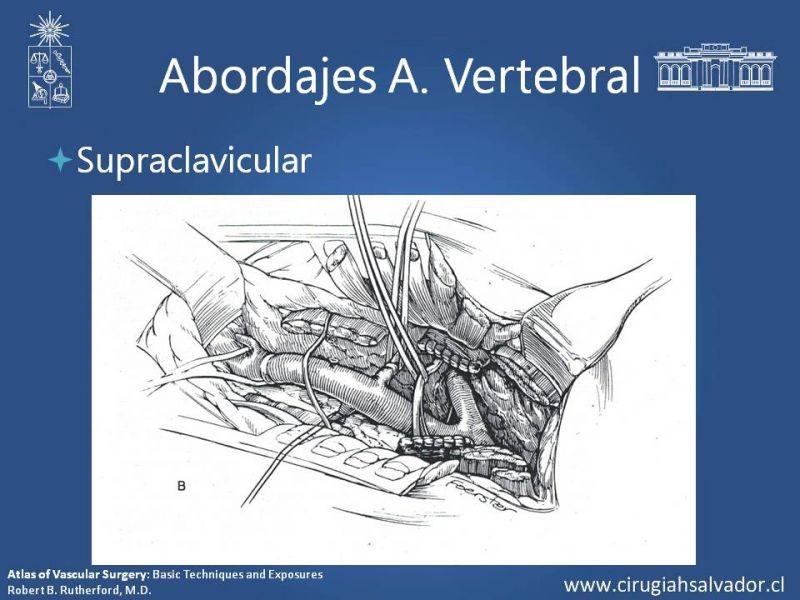 Diapositiva 27 de Anatomía Quirúrgica y Accesos de Carótida, vertebrales y subclavia