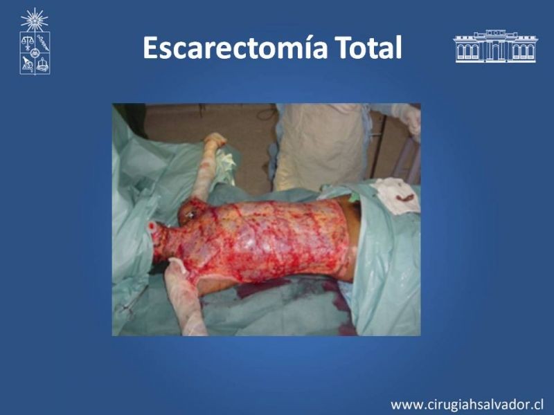 Diapositiva 17 de Manejo Quirúrgico del Gran Quemado