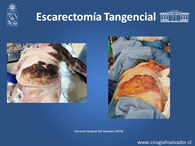 Diapositiva 16 de Manejo Quirúrgico del Gran Quemado