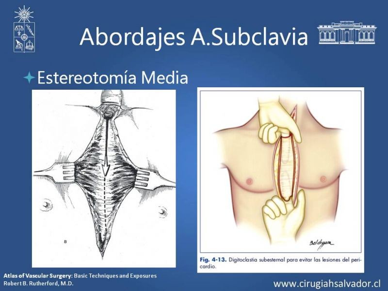 Diapositiva 12 de Anatomía Quirúrgica y Accesos de Carótida, vertebrales y subclavia