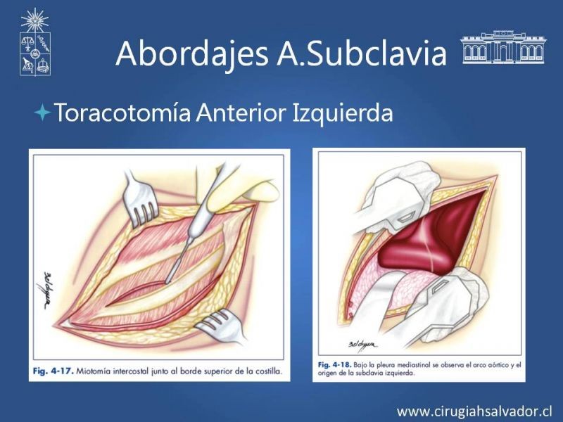Diapositiva 17 de Anatomía Quirúrgica y Accesos de Carótida, vertebrales y subclavia