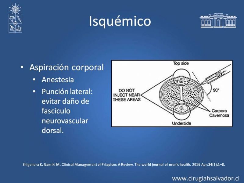 Diapositiva 18 de Priapismo