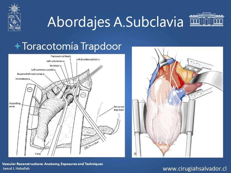Diapositiva 19 de Anatomía Quirúrgica y Accesos de Carótida, vertebrales y subclavia